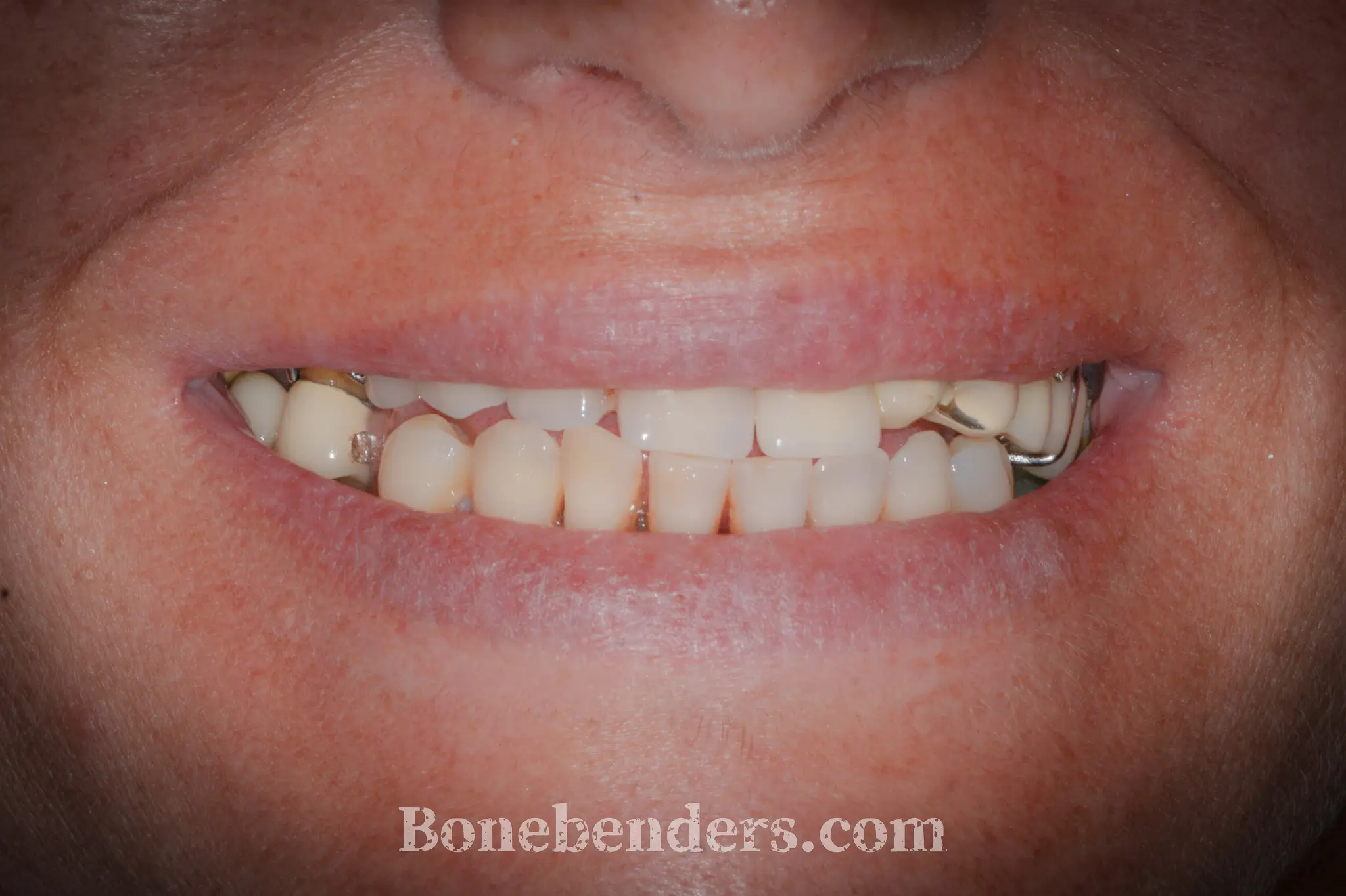 Sorriso compromesso con protesi parziale rimovibile, elementi residui incongrui e ganci metallici visibili — situazione clinica pre-operatoria