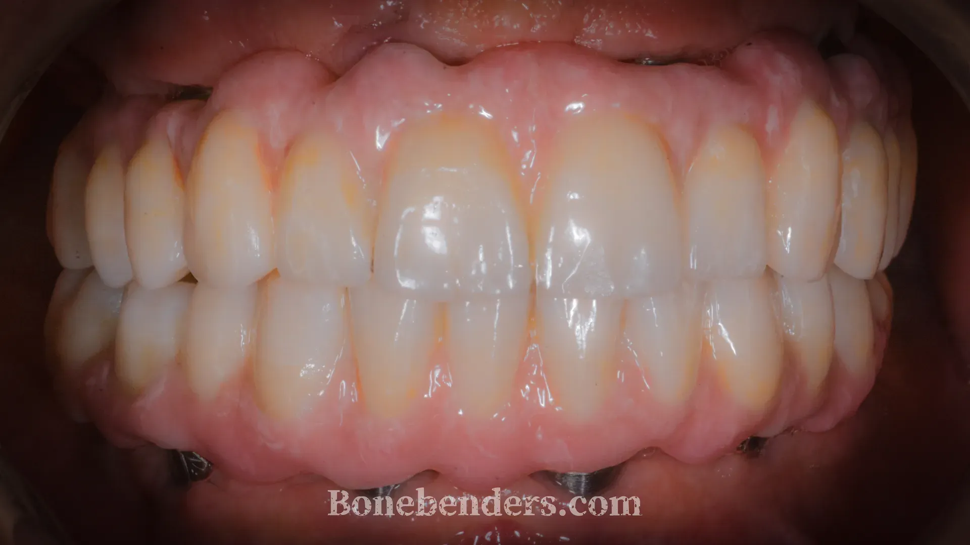 Protesi bi-mascellare definitiva in zirconia FP3 su sei impianti per arcata — risultato a 12 mesi