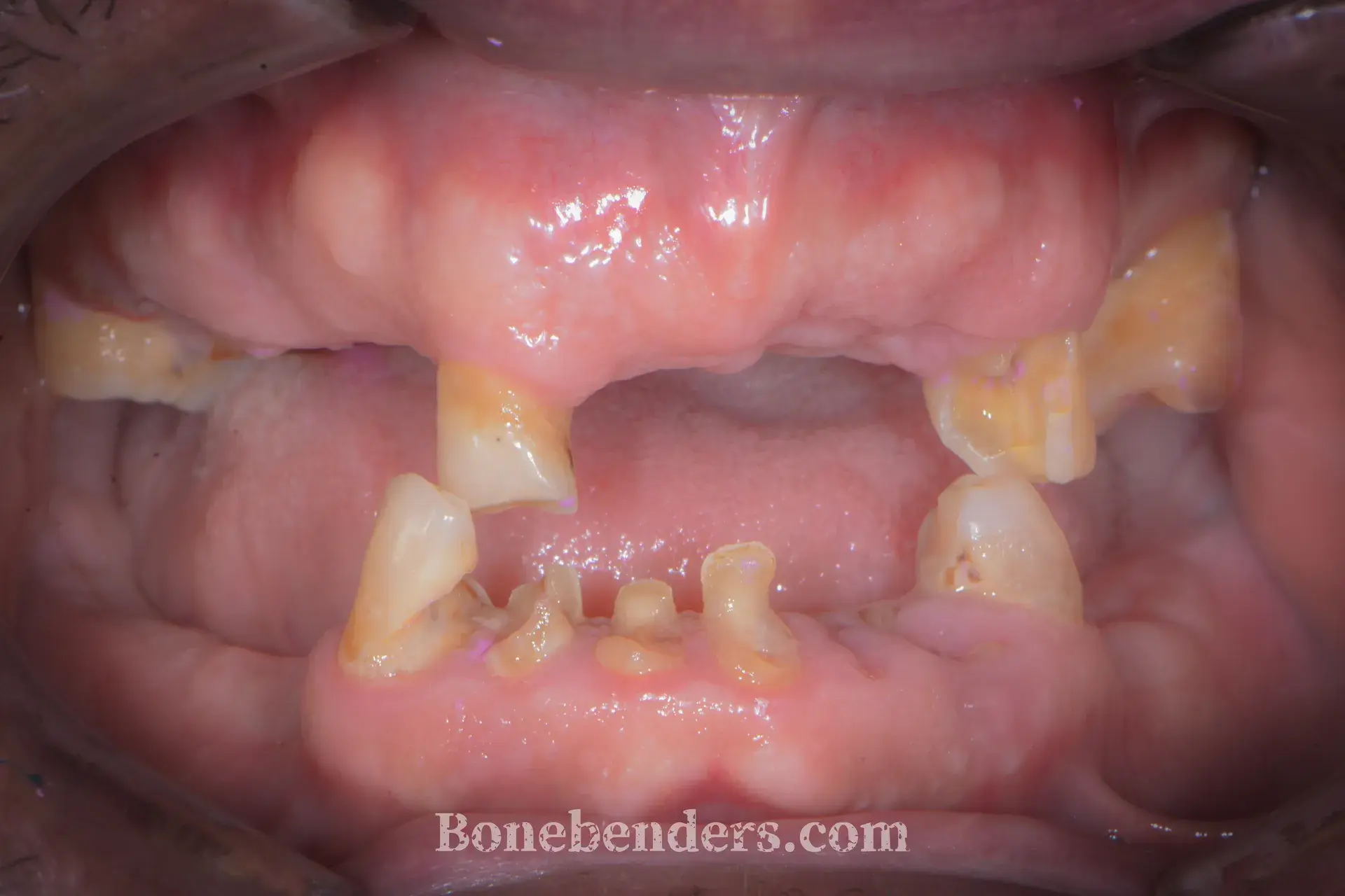 Edentulia quasi totale con elementi residui irrecuperabili — situazione clinica pre-operatoria