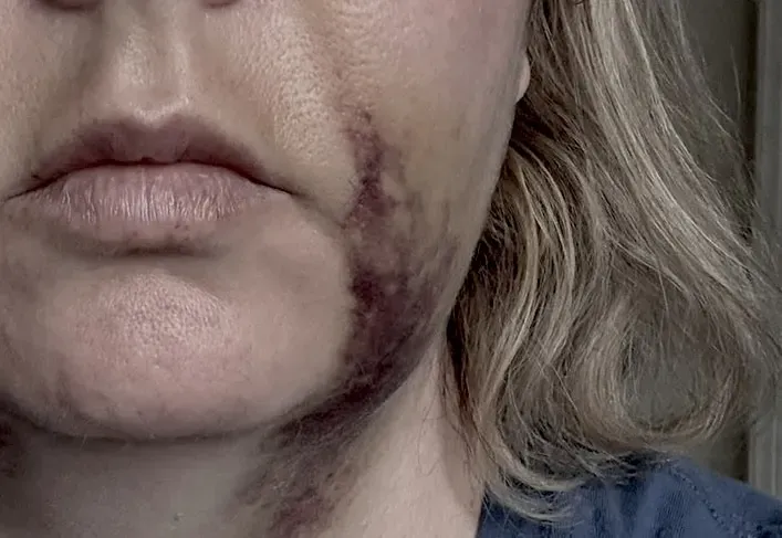 bruising and edema after GBR