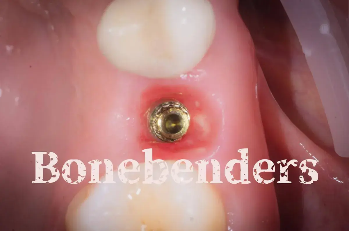 Bonebending vs GBR: the key advantages of alveolar ridge expansion