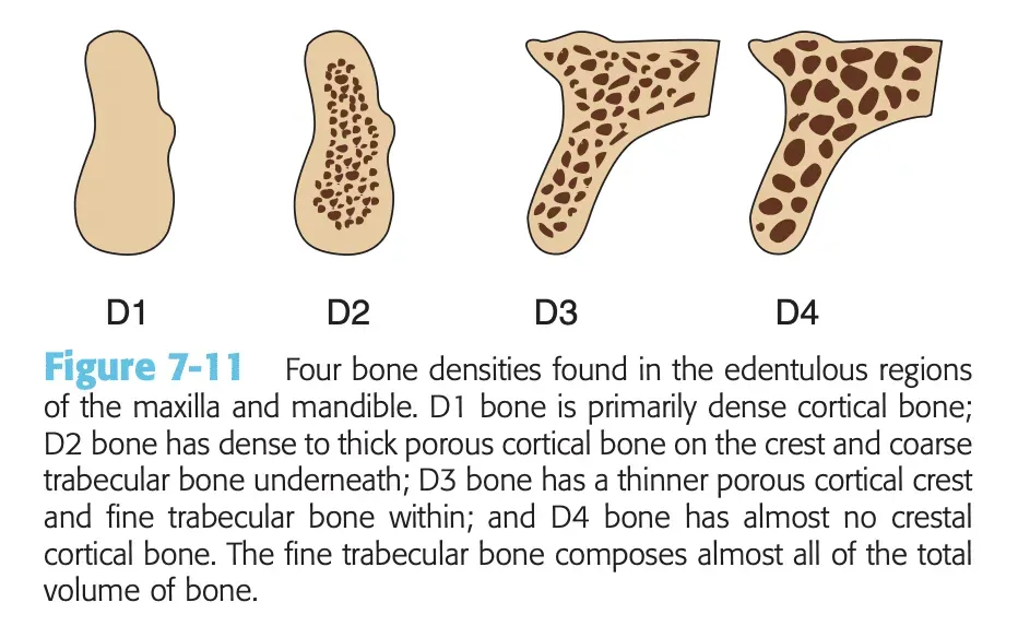 Quattro immagini che rappresentano le densità ossee D1, D2, D3 e D4 nelle aree edentule della mascella e della mandibola, con descrizioni delle caratteristiche di ciascun tipo di osso.