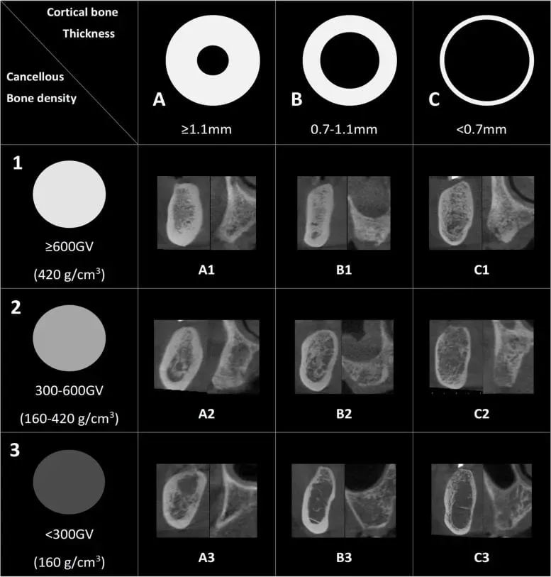 Tabella delle classificazioni ossee con spessore corticale e densità spongiosa, mostrando tre categorie per ciascuno: A, B, C e tre livelli di densità.