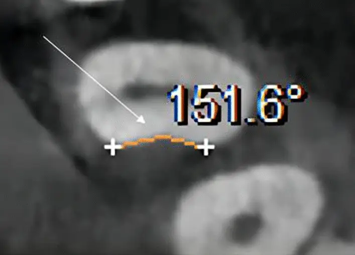 CBCT di primo premolare mascellare con concavità mesiale e misurazione angolare