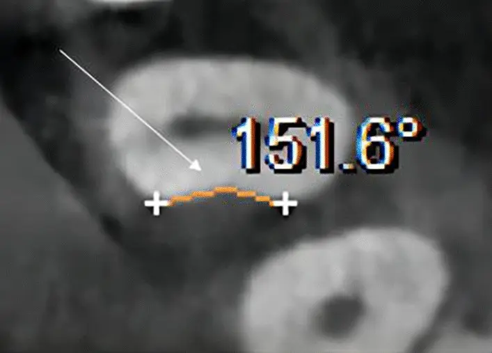 CBCT di primo premolare mascellare con concavità mesiale e misurazione angolare