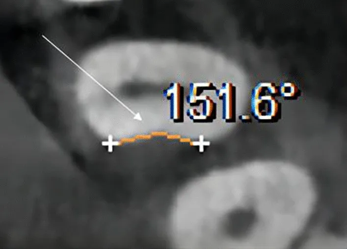 CBCT di primo premolare mascellare con concavità mesiale e misurazione angolare