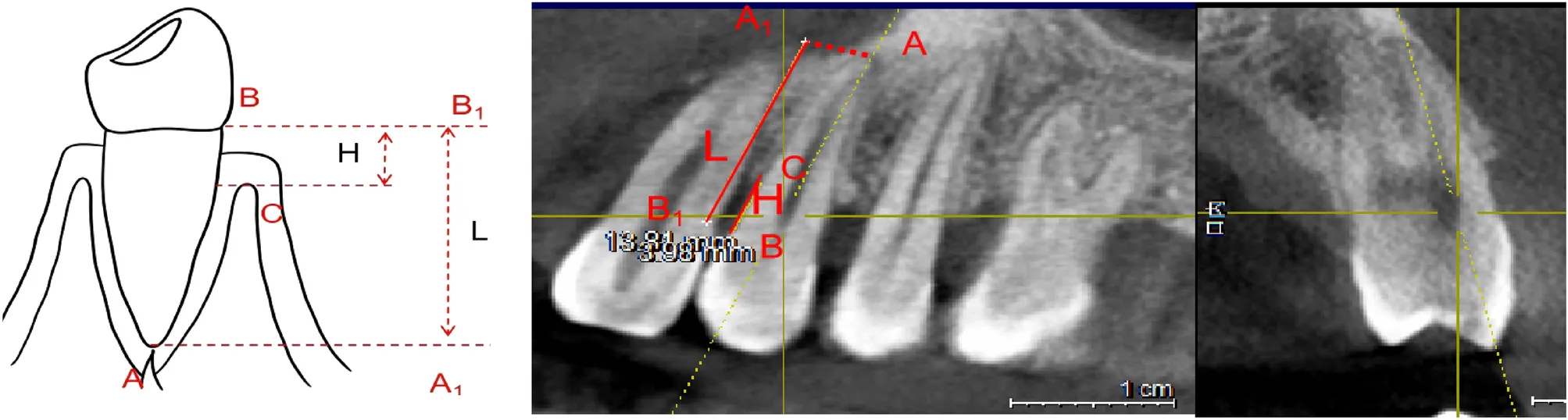 Punti di repere anatomici per la misurazione della concavità mesiale e del riassorbimento osseo alveolare: schema e correlazione CBCT. Immagine: Chen et al., 2024, Scientific Reports — CC-BY 4.0