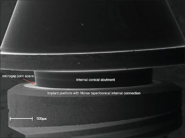 Immagine che mostra un impianto dentale con una connessione conica di Morse, evidenziando lo spazio del microgap tra l