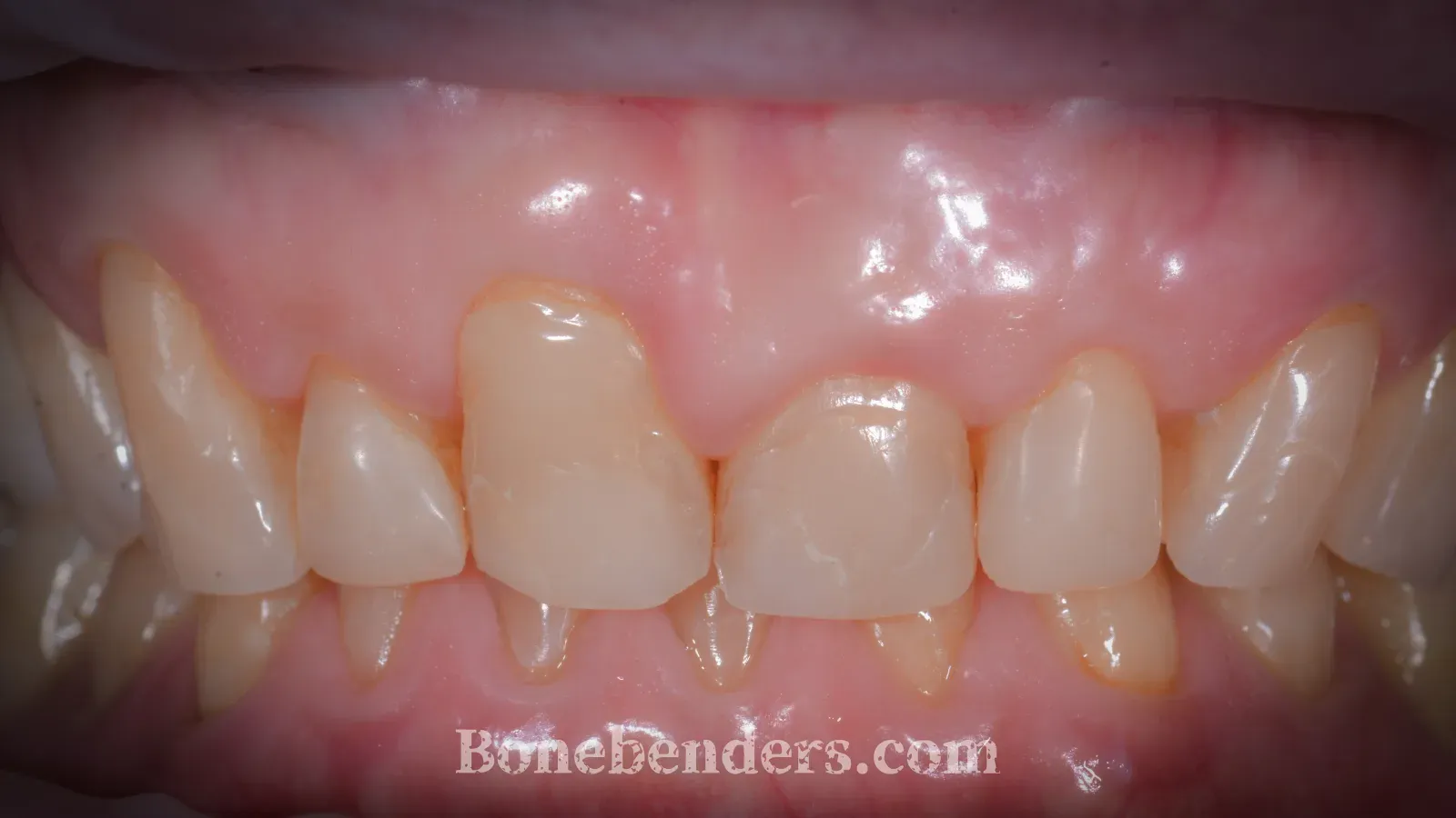Recessione gengivale sull'incisivo centrale superiore destro (1.1), dente vestibolarizzato e usurato, margini gengivali disallineati — fotografia intraorale pre-operatoria