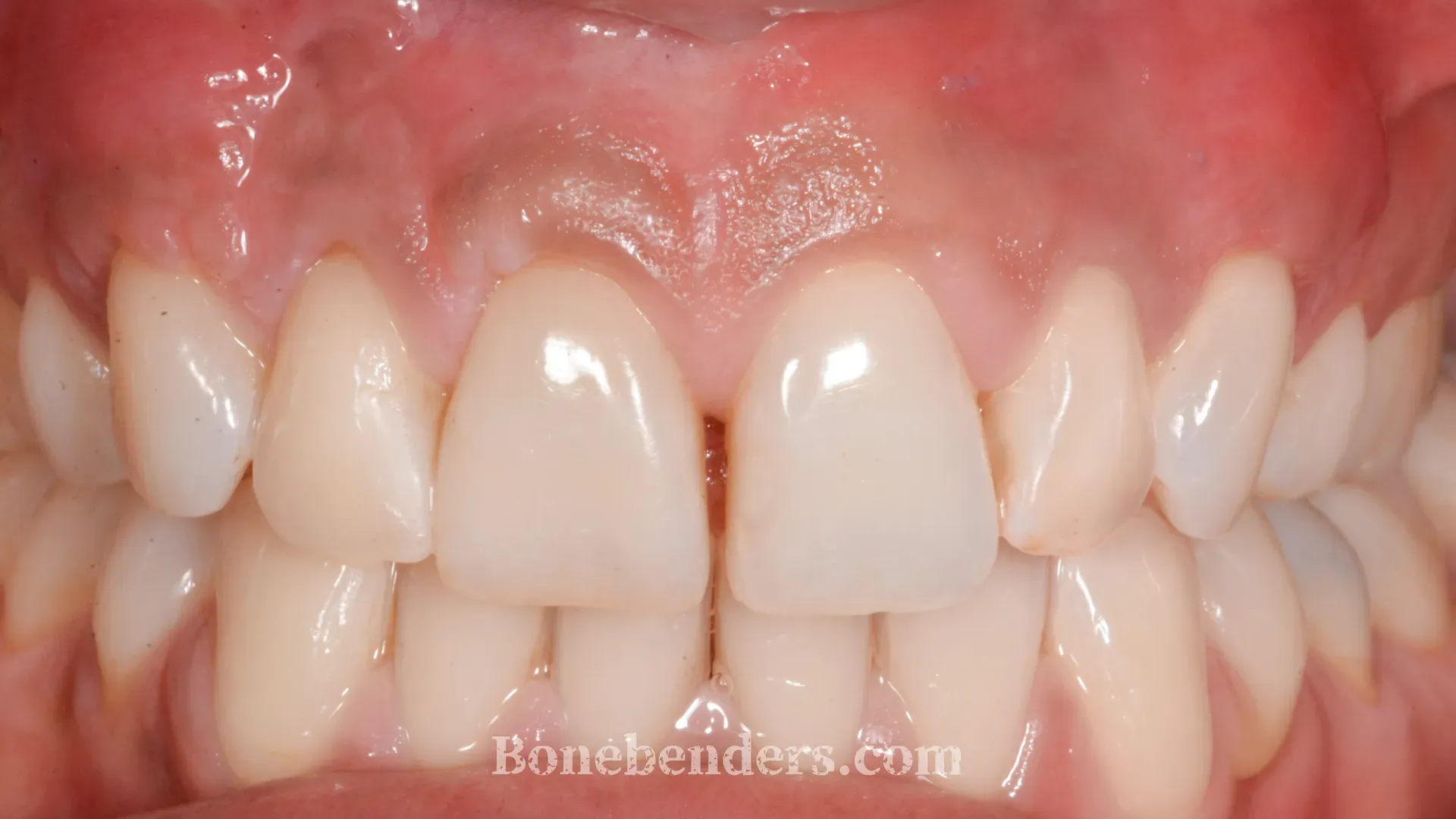 Copertura radicolare completa dopo innesto connettivale e lembo coronale — risultato a 2 mesi