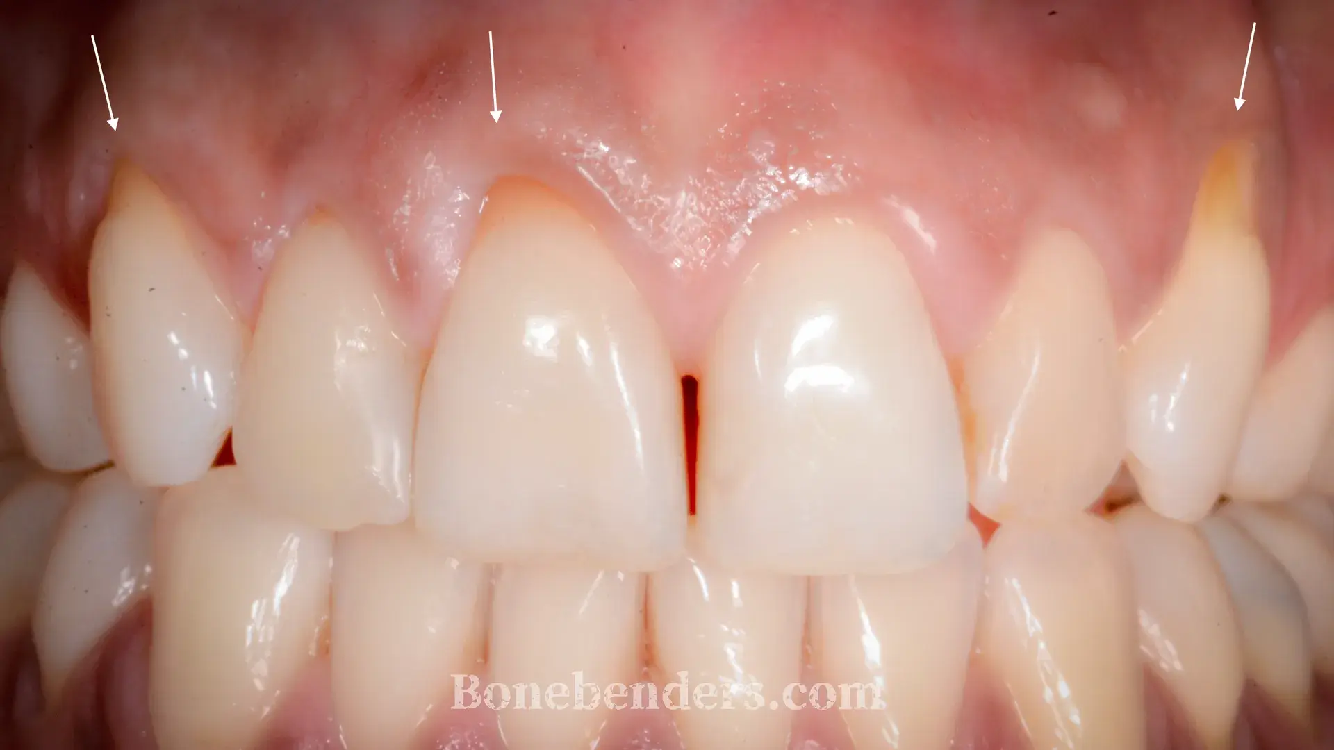 Recessioni gengivali gravi su canini e incisivo centrale superiore — situazione clinica pre-operatoria