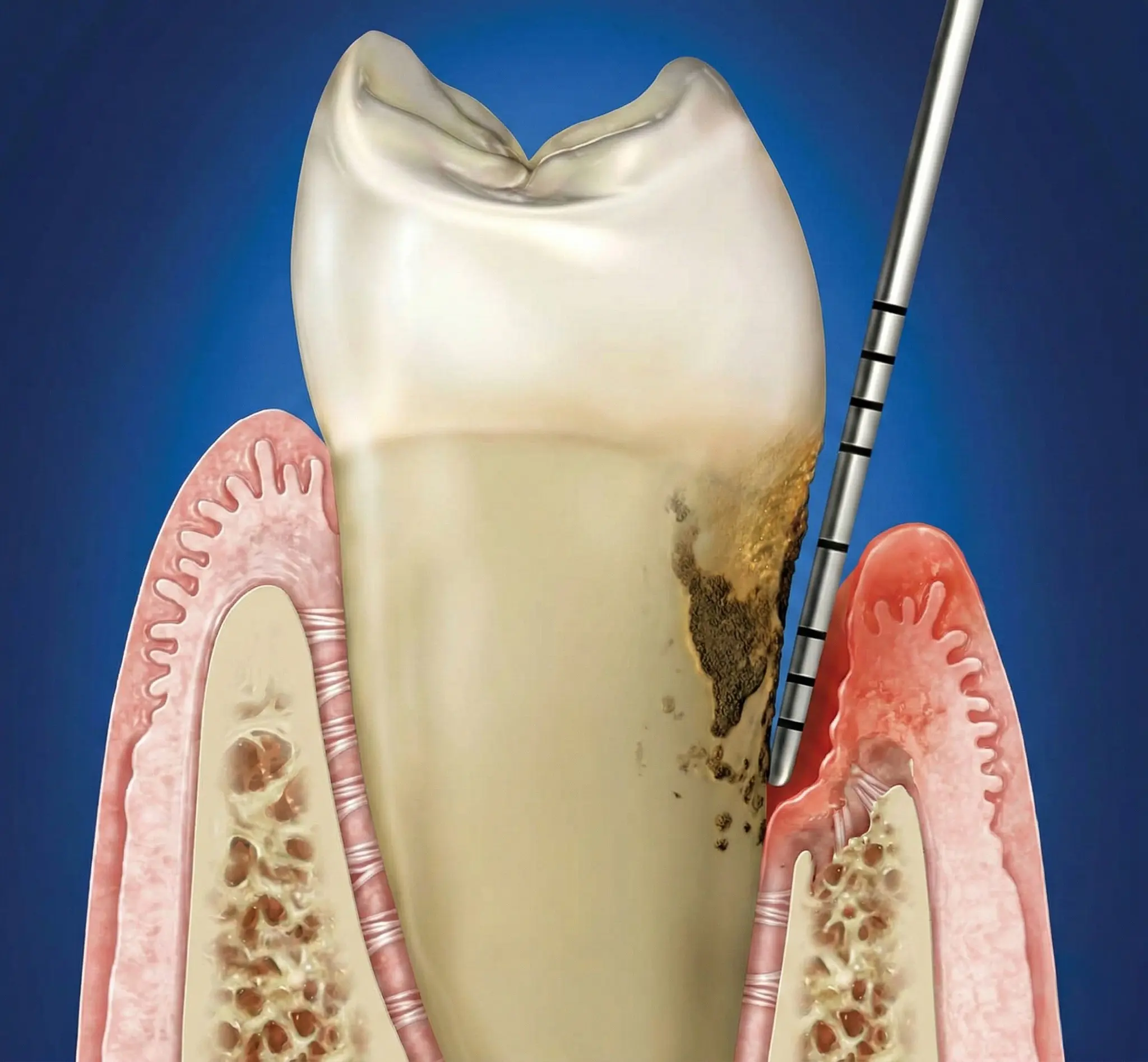 Cura delle gengive a Frosinone — sondaggio parodontale nello Studio Denti Più