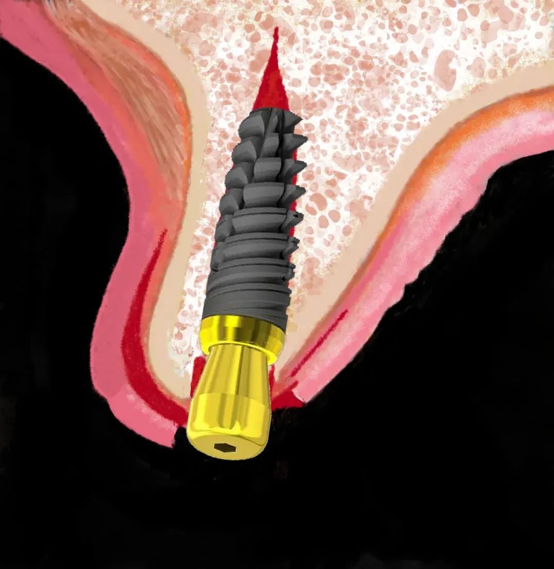 Deficit ossei orizzontali: la meta-analisi su 1.400 impianti