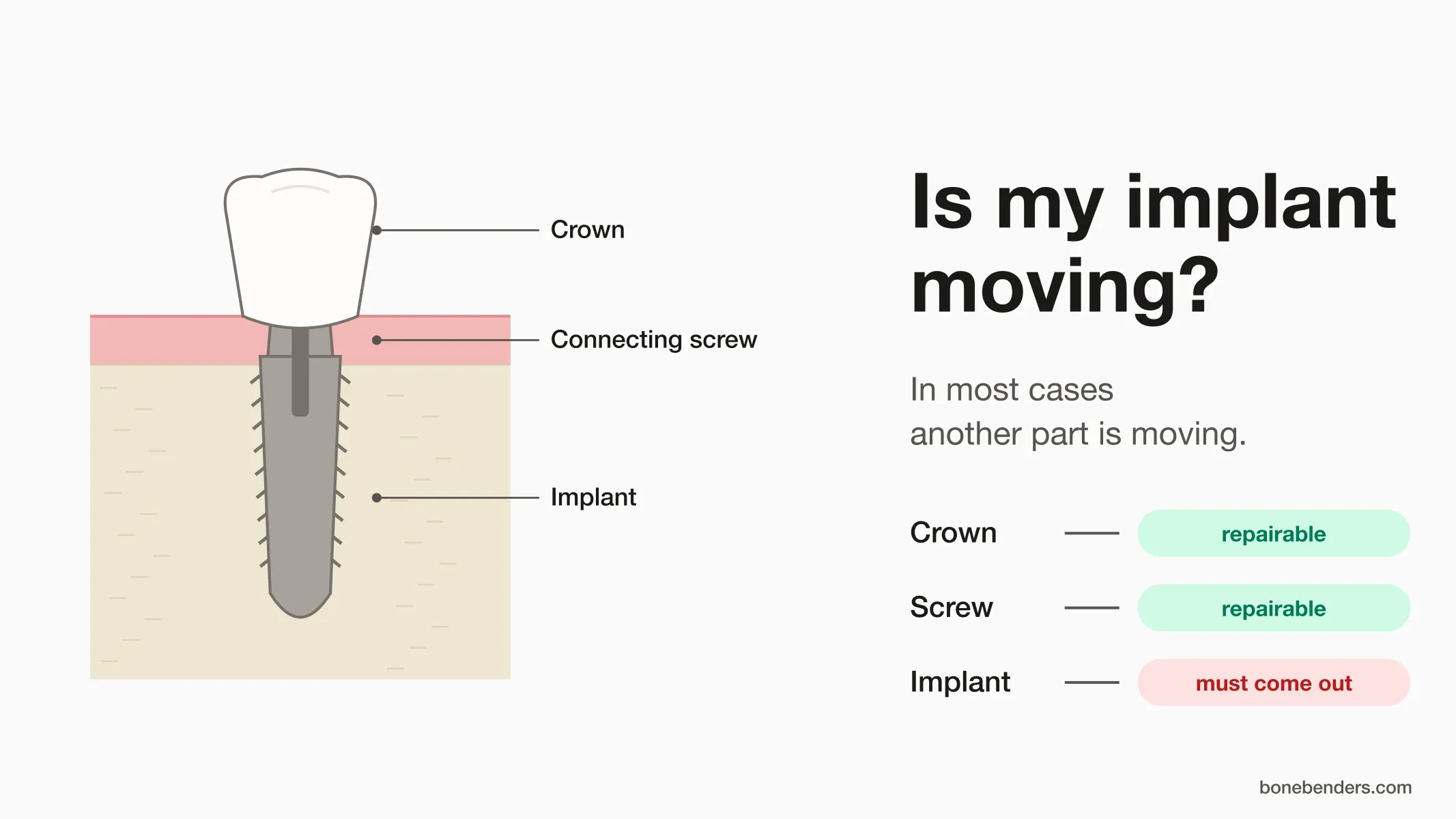 Diagram of a dental implant with crown, connecting screw and implant: crown and screw can be repaired, a mobile implant must come out