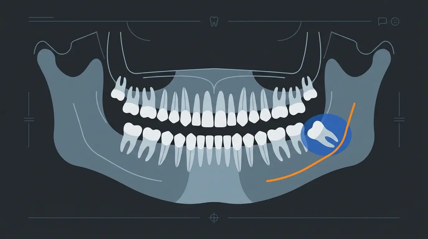 Dente del giudizio incluso in mandibola: ortopantomografia e indicazioni chirurgiche