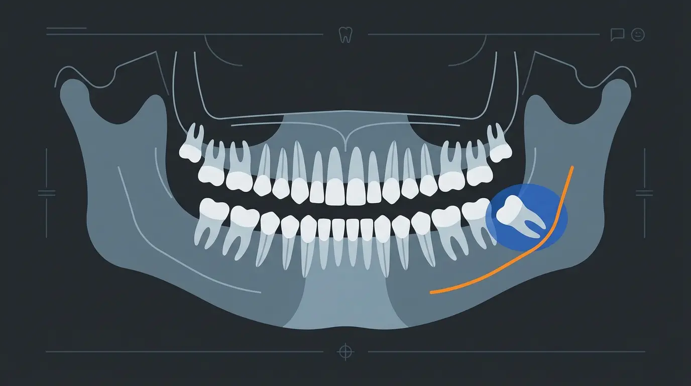 Dente del giudizio incluso in mandibola: ortopantomografia e indicazioni chirurgiche