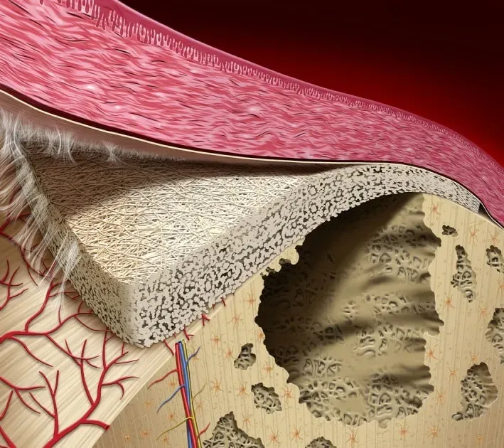 Detailed cross-section illustrating the principles of guided bone regeneration.