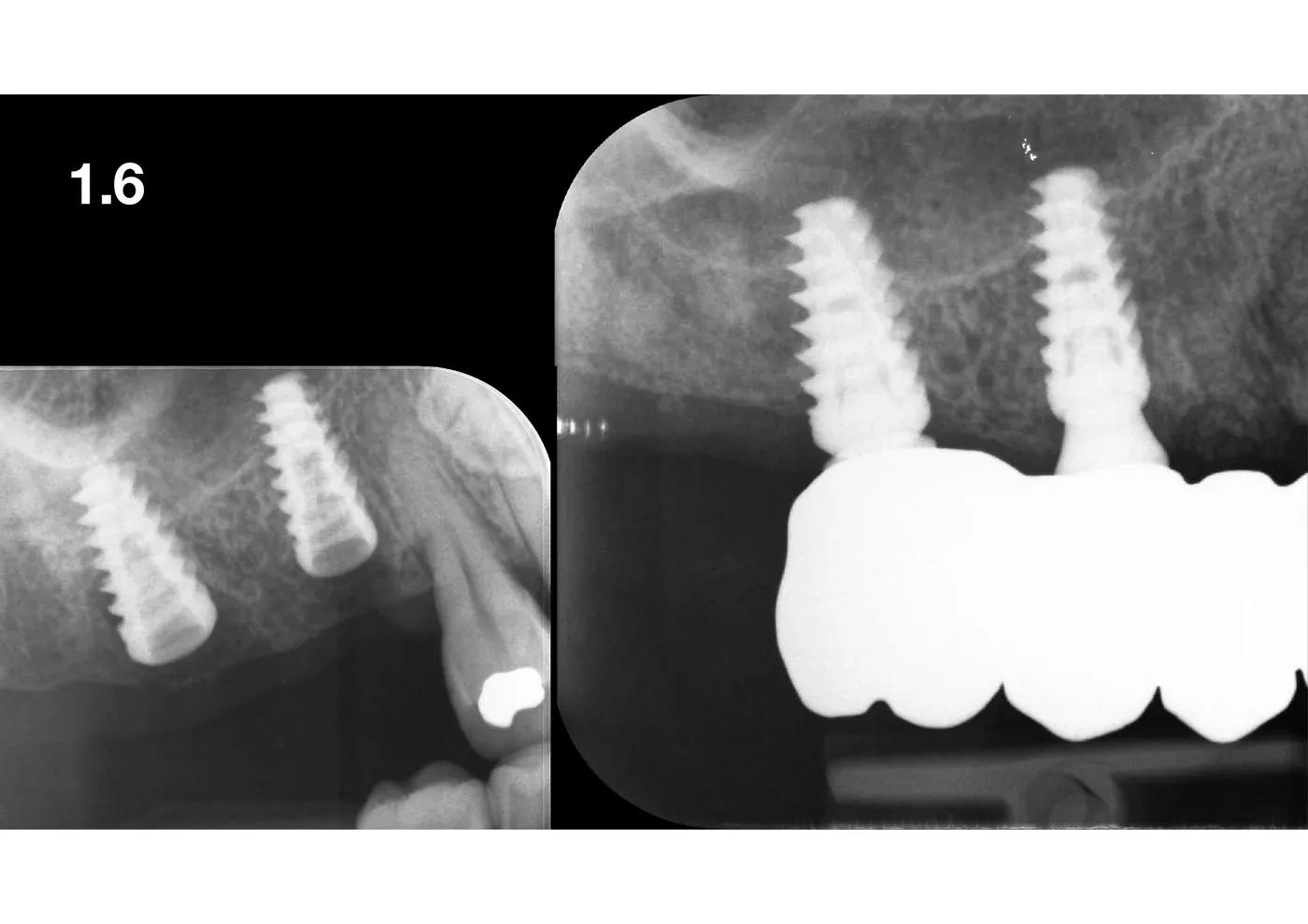Radiografie di controllo a lungo termine con i due impianti in 1.6 e 1.5 e le corone definitive in posizione, livelli ossei stabili
