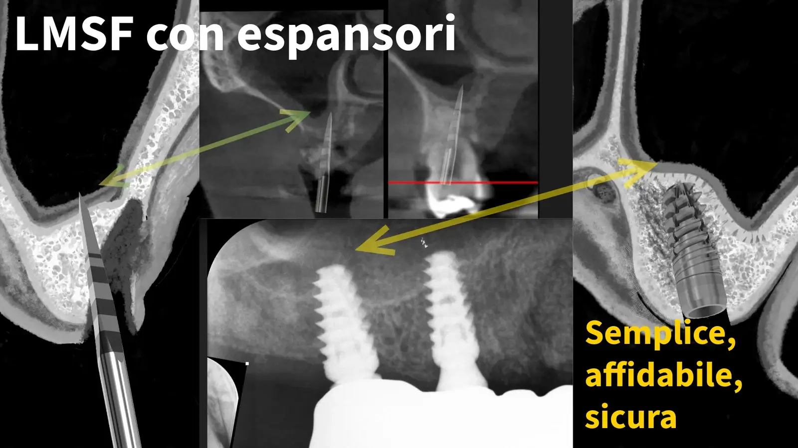 Editorial cover «LMSF with expanders — simple, reliable, safe»: composite of CBCT sections, screw expanders and radiographic outcomes of the two implants integrated in the augmented sinus, no graft