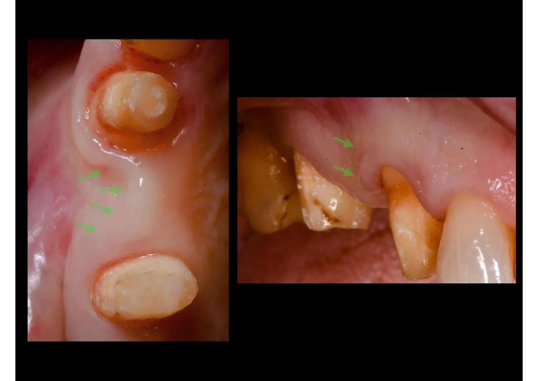 Situazione clinica pre-operatoria: visione occlusale e laterale del primo premolare superiore compromesso