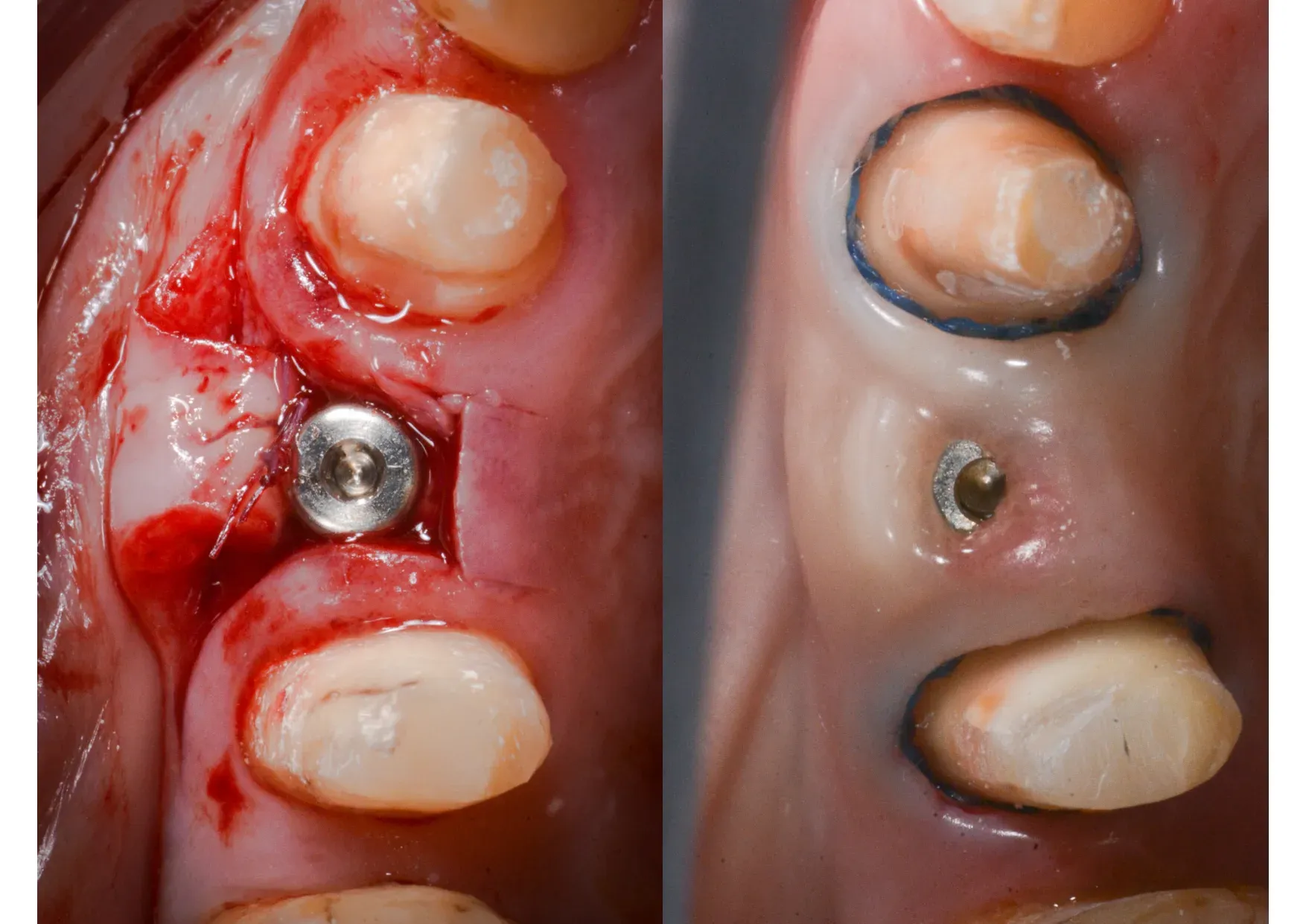 Vite di guarigione posizionata e maturazione dei tessuti molli attorno all'emergenza implantare