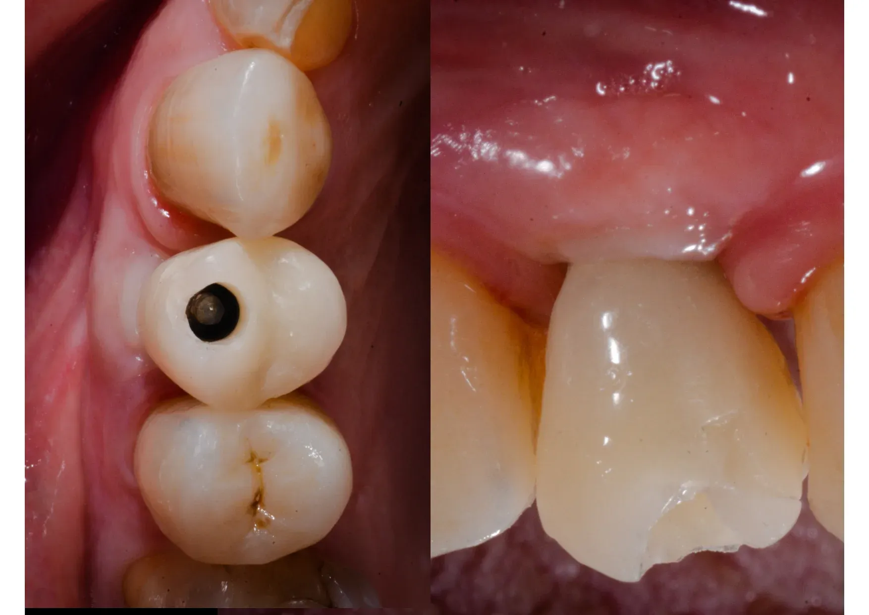 Protesizzazione: corona avvitata sull'impianto e visione vestibolare del risultato