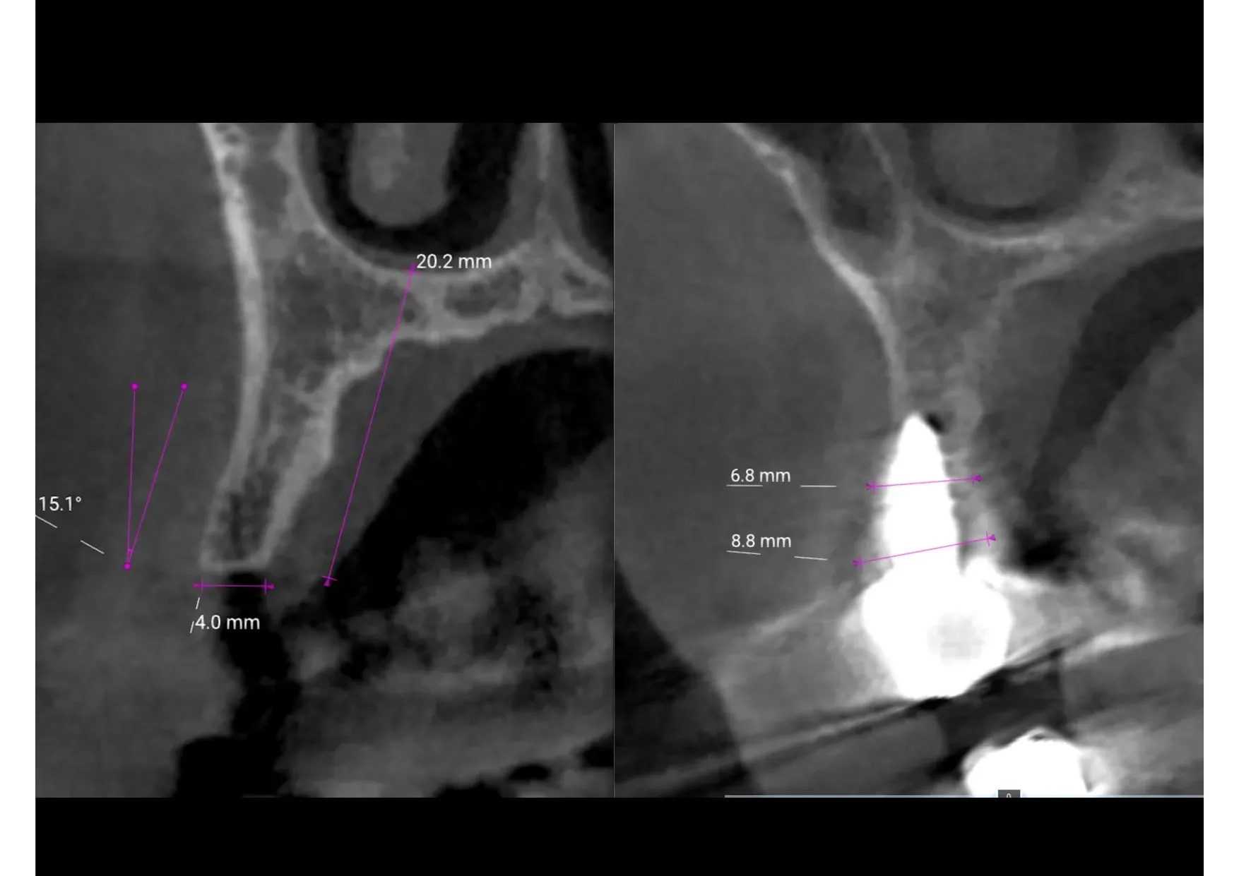 CBCT pre-operatoria: scansioni con misurazioni della cresta alveolare — spessore 4,0 mm, altezza disponibile 20,2 mm