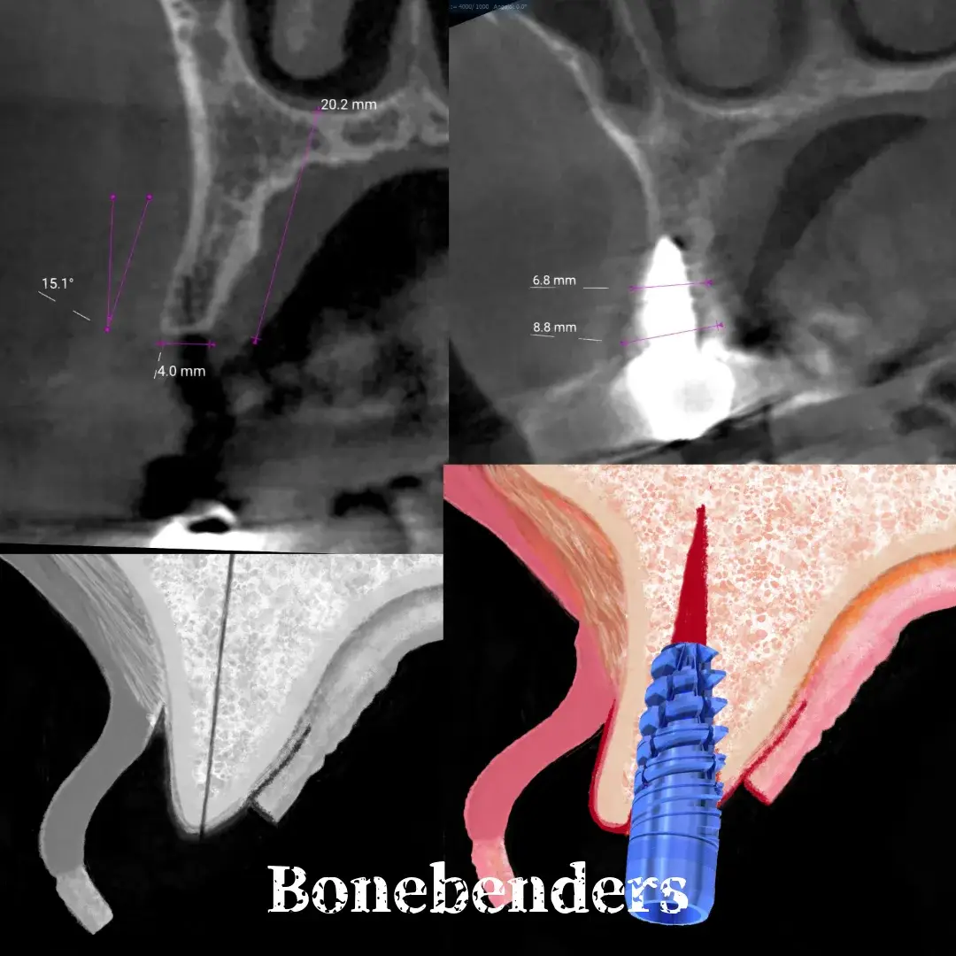 CBCT and illustration of ERE ridge expansion technique with immediate implant placement