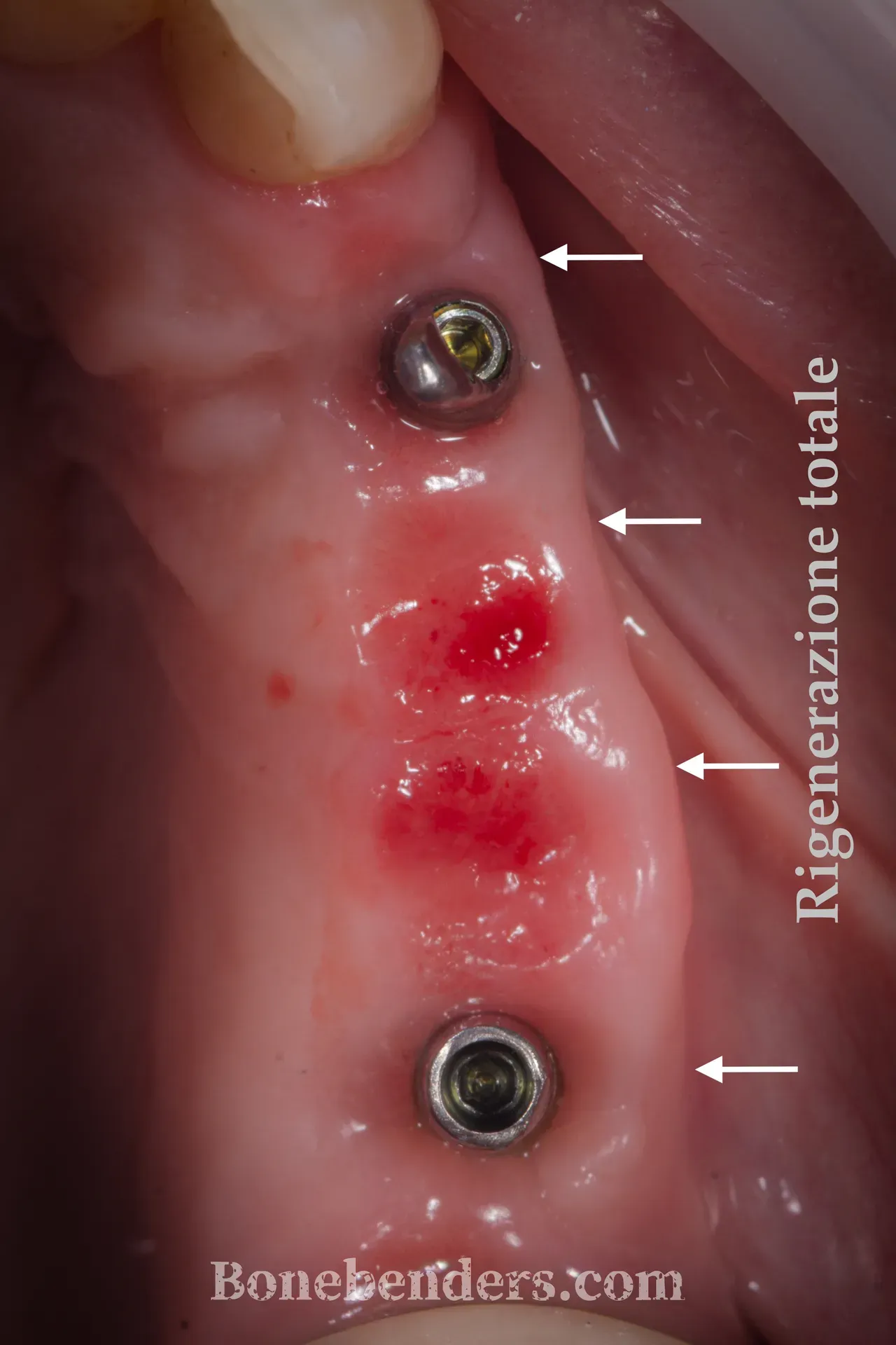 Impianti osteointegrati in cresta espansa — radiografia periapicale a 12 mesi