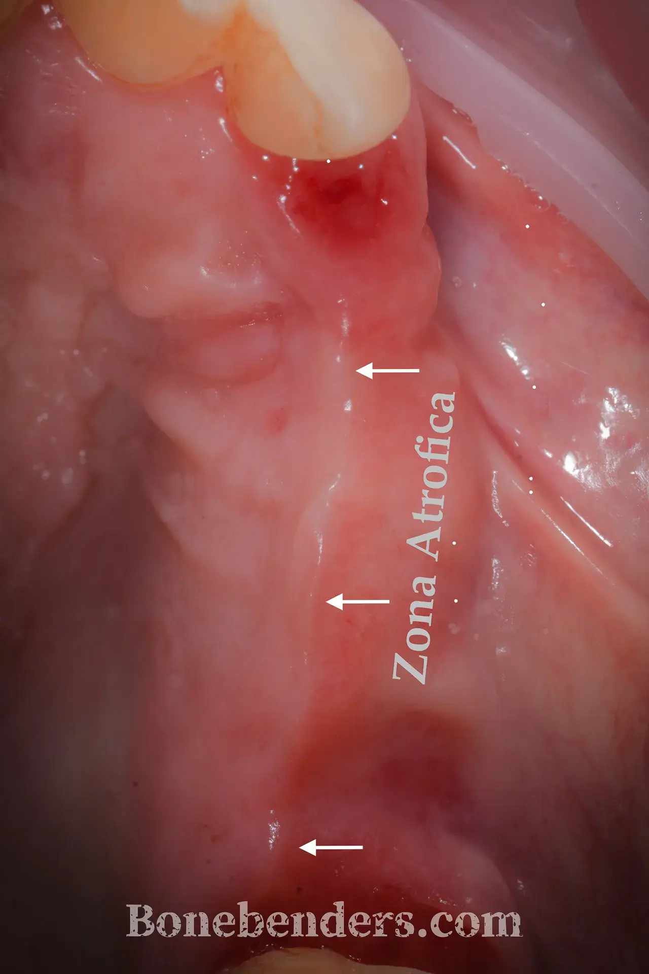 Cresta alveolare atrofica mascellare posteriore destro — sezione CBCT pre-operatoria