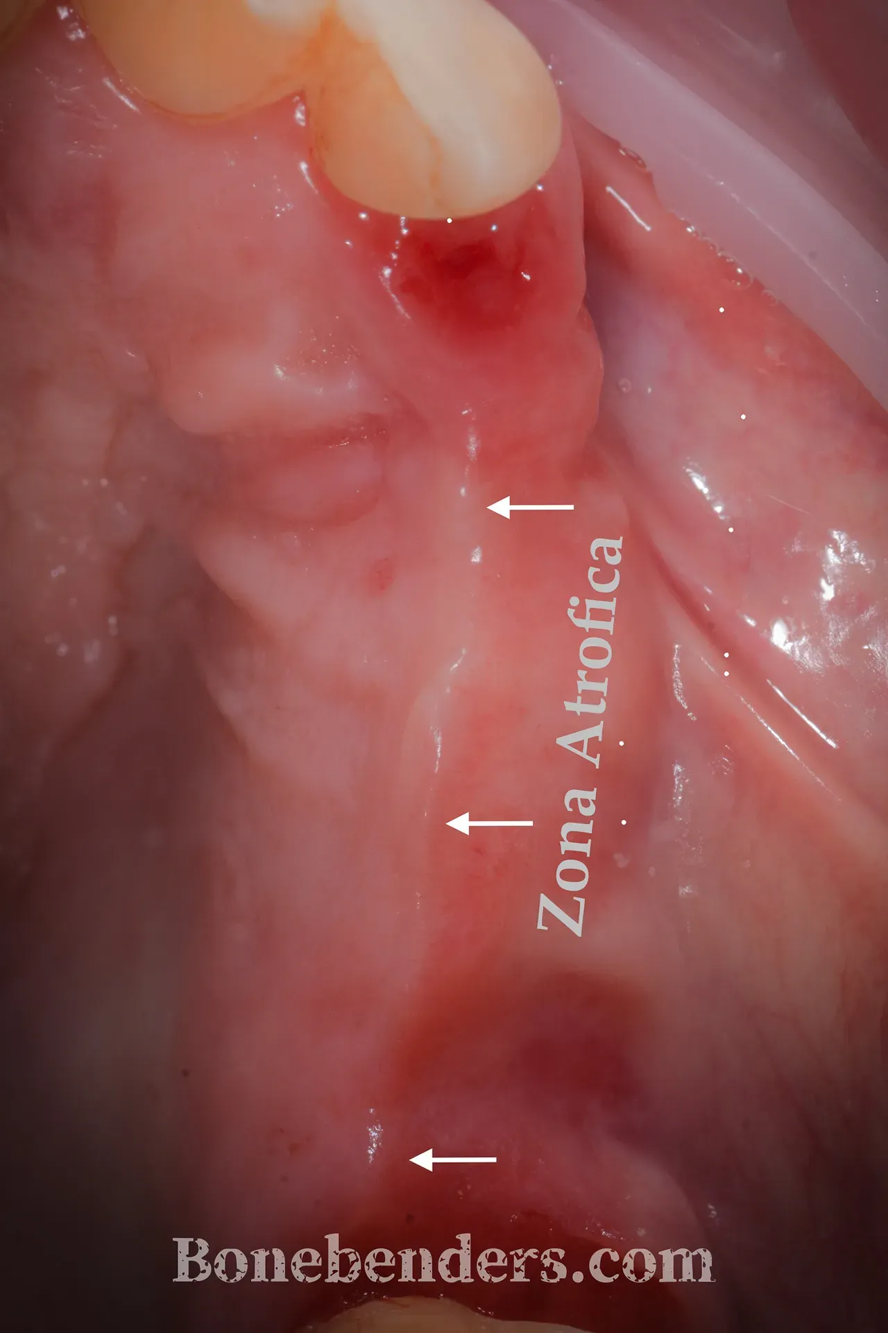 Cresta alveolare atrofica mascellare posteriore destro — sezione CBCT pre-operatoria