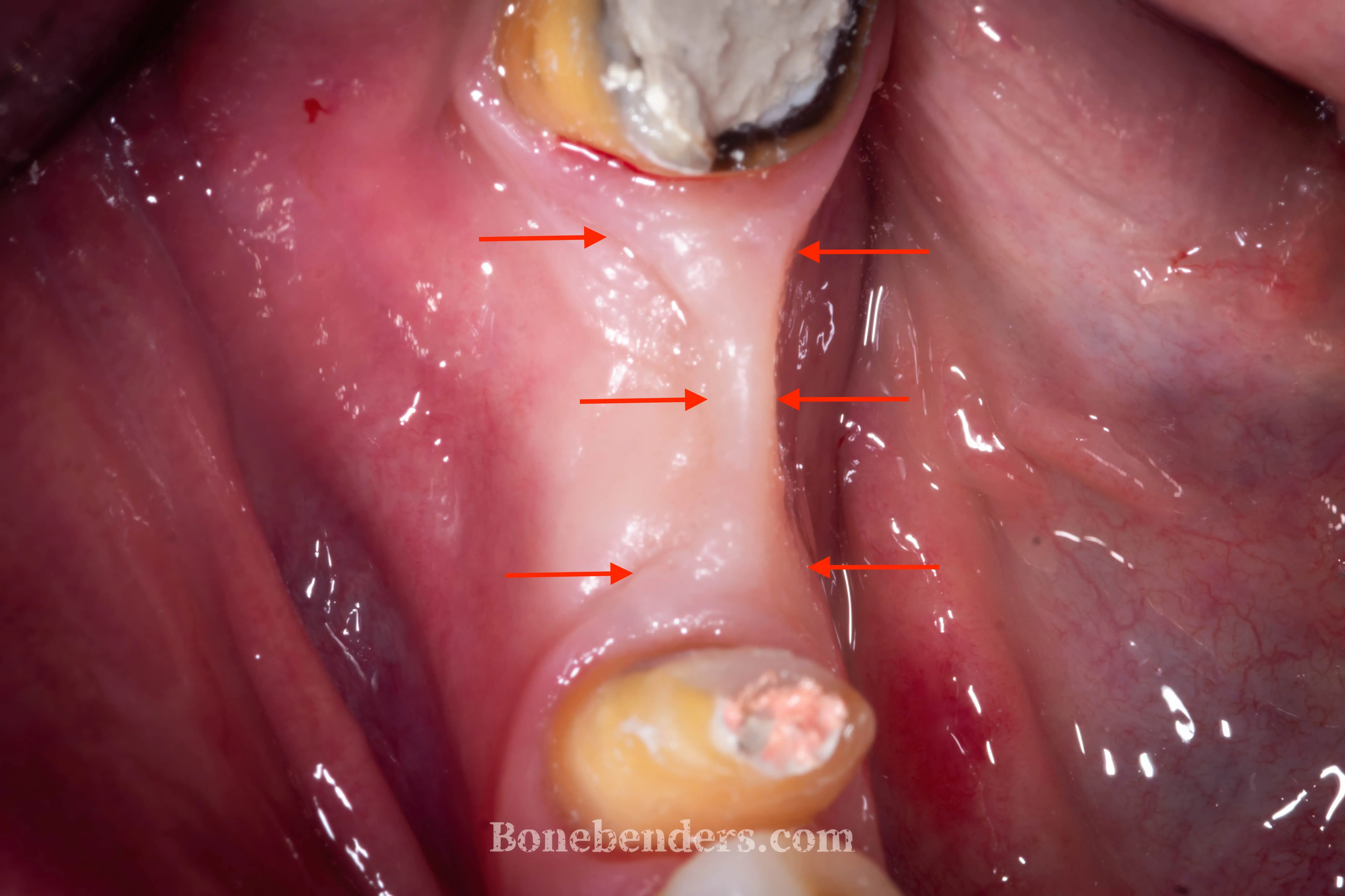Pre-operative clinical view of the 4.6 site showing the severe osteo-mucosal defect with arrows indicating the boundaries of bone and keratinised tissue deficiency