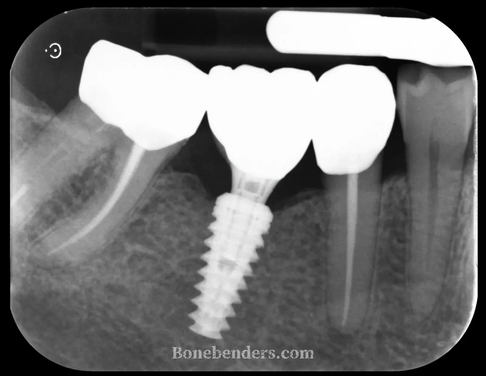 Radiografia di controllo finale del 22 ottobre 2025: corona definitiva in zona 4.6 con livelli ossei radiografici stabili e contatto osseo continuo lungo l'impianto.