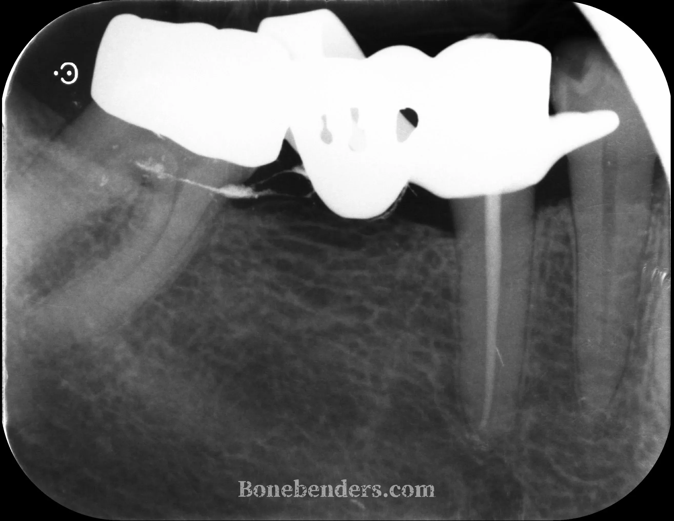 Pre-operative periapical radiograph of the 4.6 site during endodontic treatment of the adjacent teeth