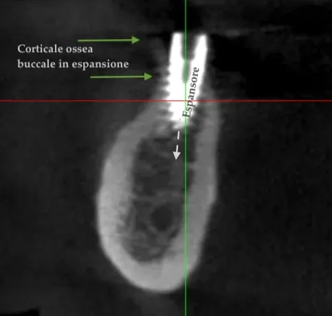 Sezione CBCT del sito chirurgico: l'espansore agisce nello spessore della cresta e la corticale buccale si flette progressivamente verso l'esterno, mantenendo continuità con il versante linguale.