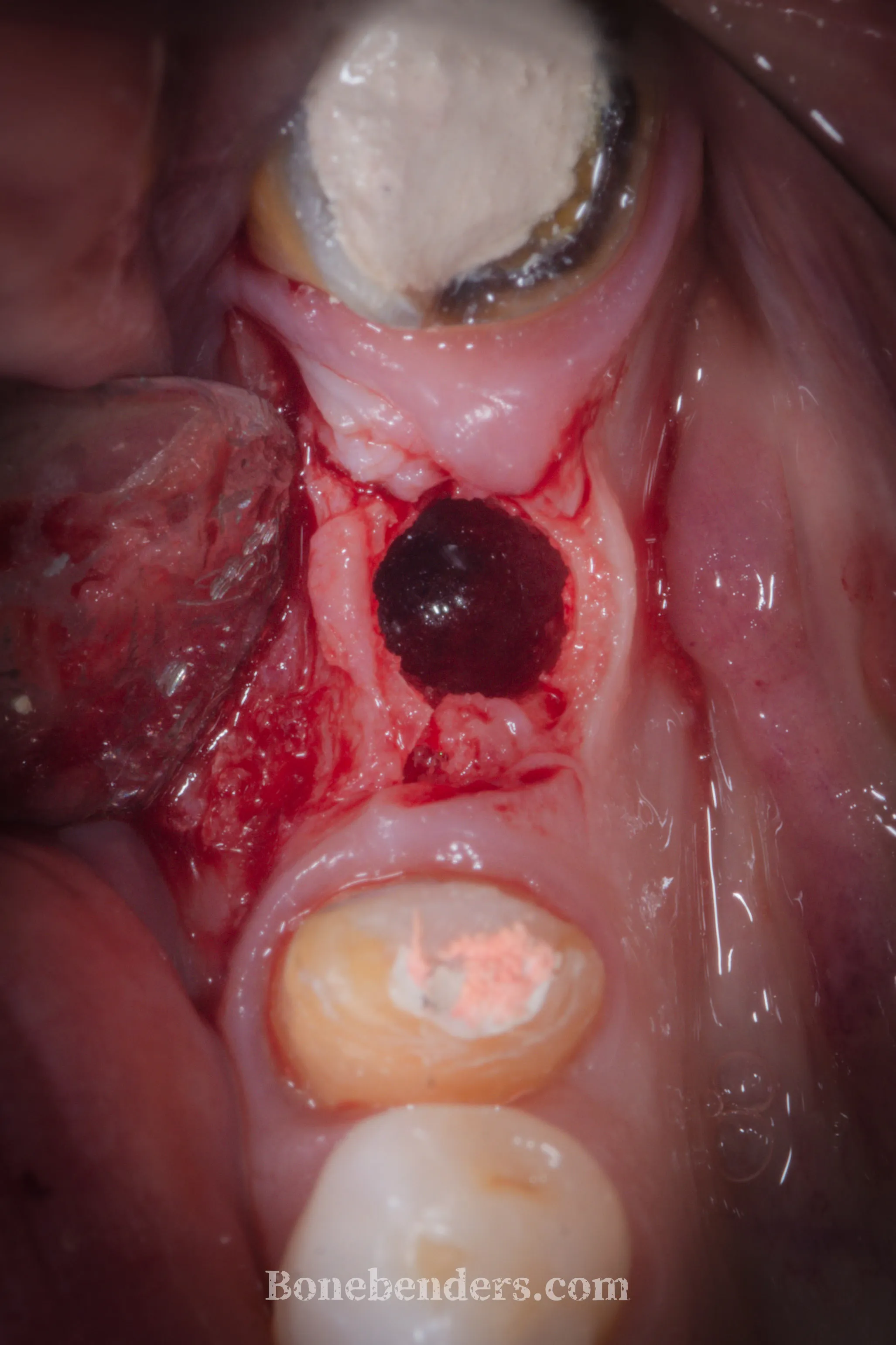 Sito chirurgico aperto a spessore parziale: l'osteotomia longitudinale è stata eseguita; il sanguinamento attivo dall'osso testimonia un substrato vitale. Si notano i denti adiacenti con sistema endodontico in fase di trattamento.