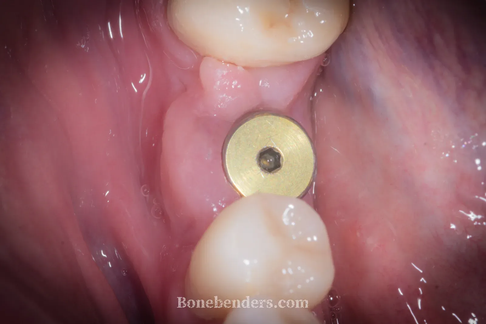 Impianto in posizione finale con vite di guarigione transmucosale: il gap osteo-mucoso laterale guarirà per seconda intenzione, senza innesto né membrana.