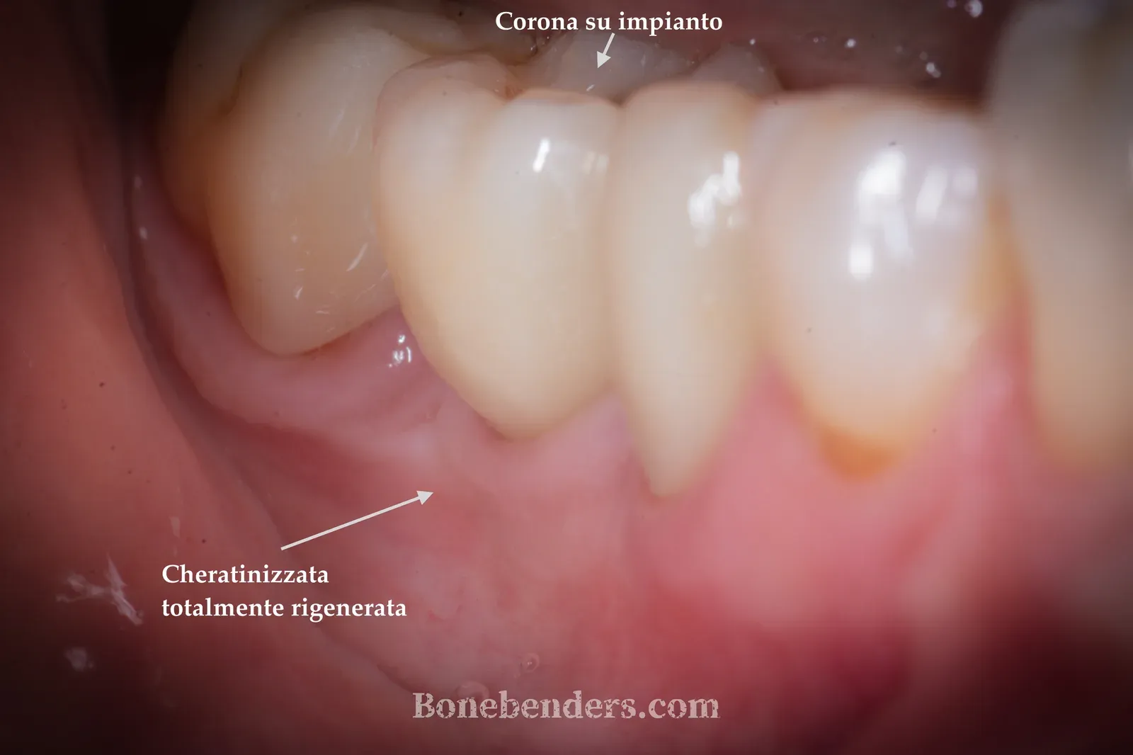 Aspetto clinico finale annotato: corona definitiva su impianto in zona 4.6 e cheratinizzata totalmente rigenerata sul versante vestibolare, con integrazione estetica completa con i denti adiacenti.