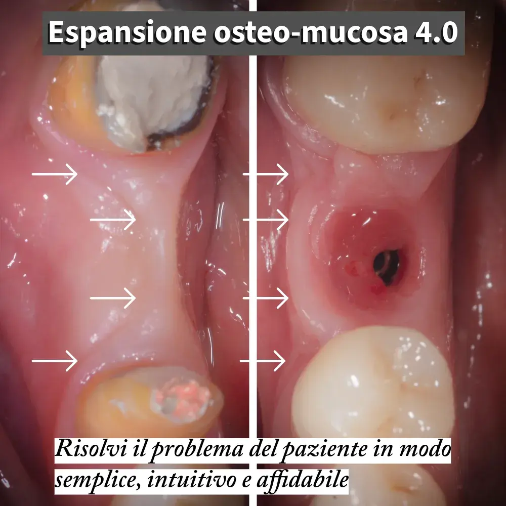 Sito mandibolare in zona 4.6 con difetto osteo-mucoso severo, cresta concava e mucosa cheratinizzata quasi assente (limiti indicati dalle frecce) — situazione clinica pre-operatoria.