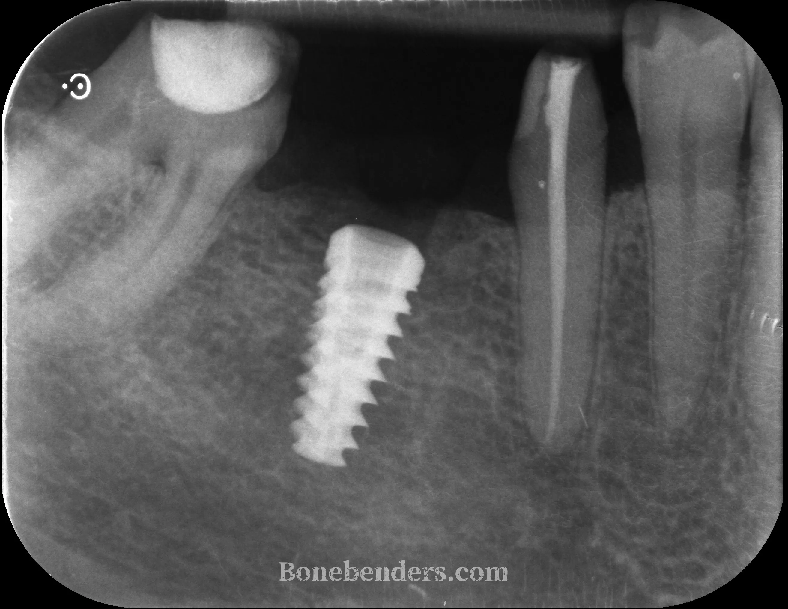 Radiografia periapicale post-operatoria: impianto in zona 4.6 correttamente posizionato dopo espansione osteo-mucosa, senza innesti né membrane.