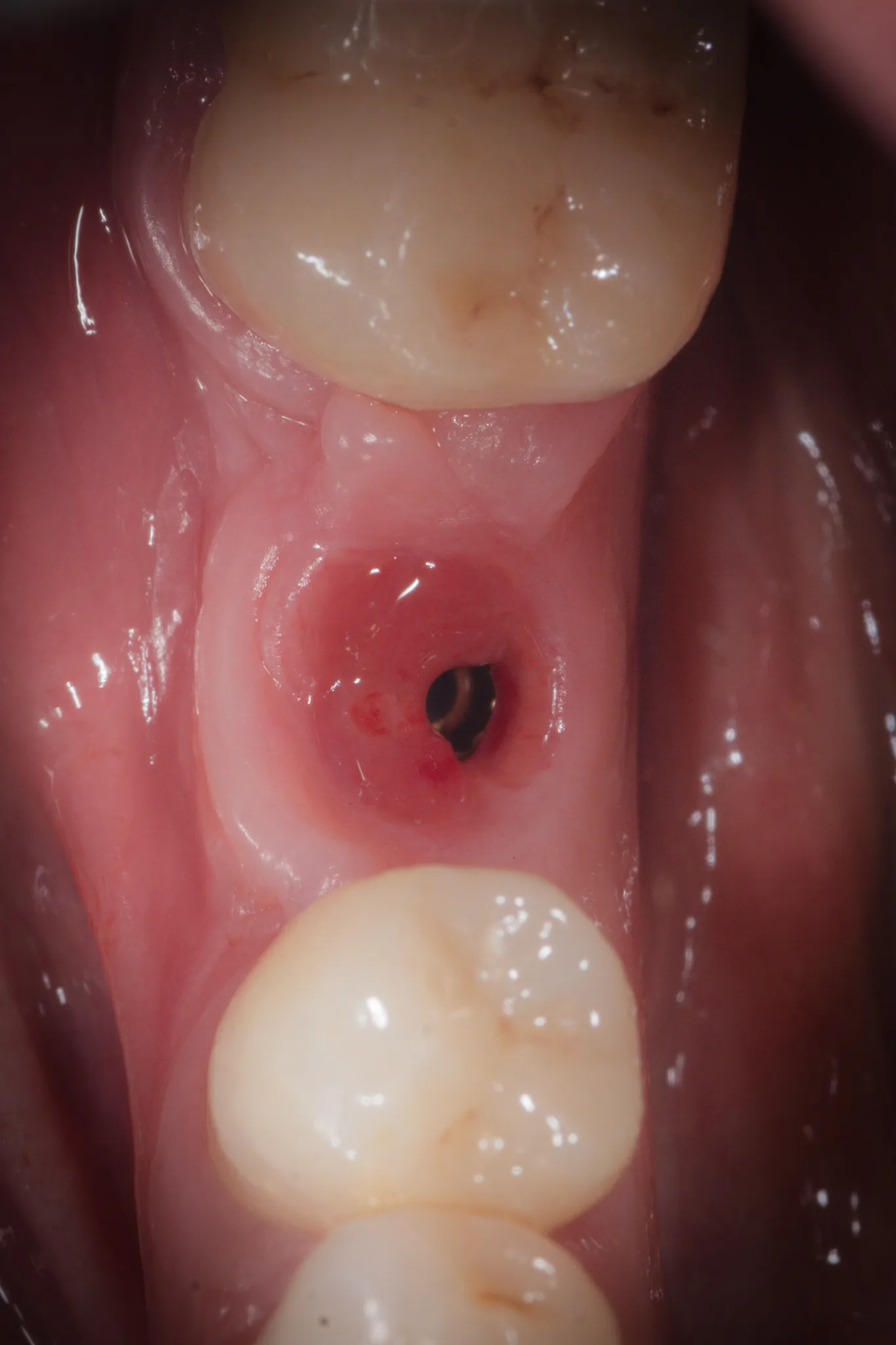 Vista clinica occlusale a guarigione completata: impianto con vite di guarigione transmucosale, ampia banda di mucosa cheratinizzata neoformata, denti adiacenti restaurati con corone