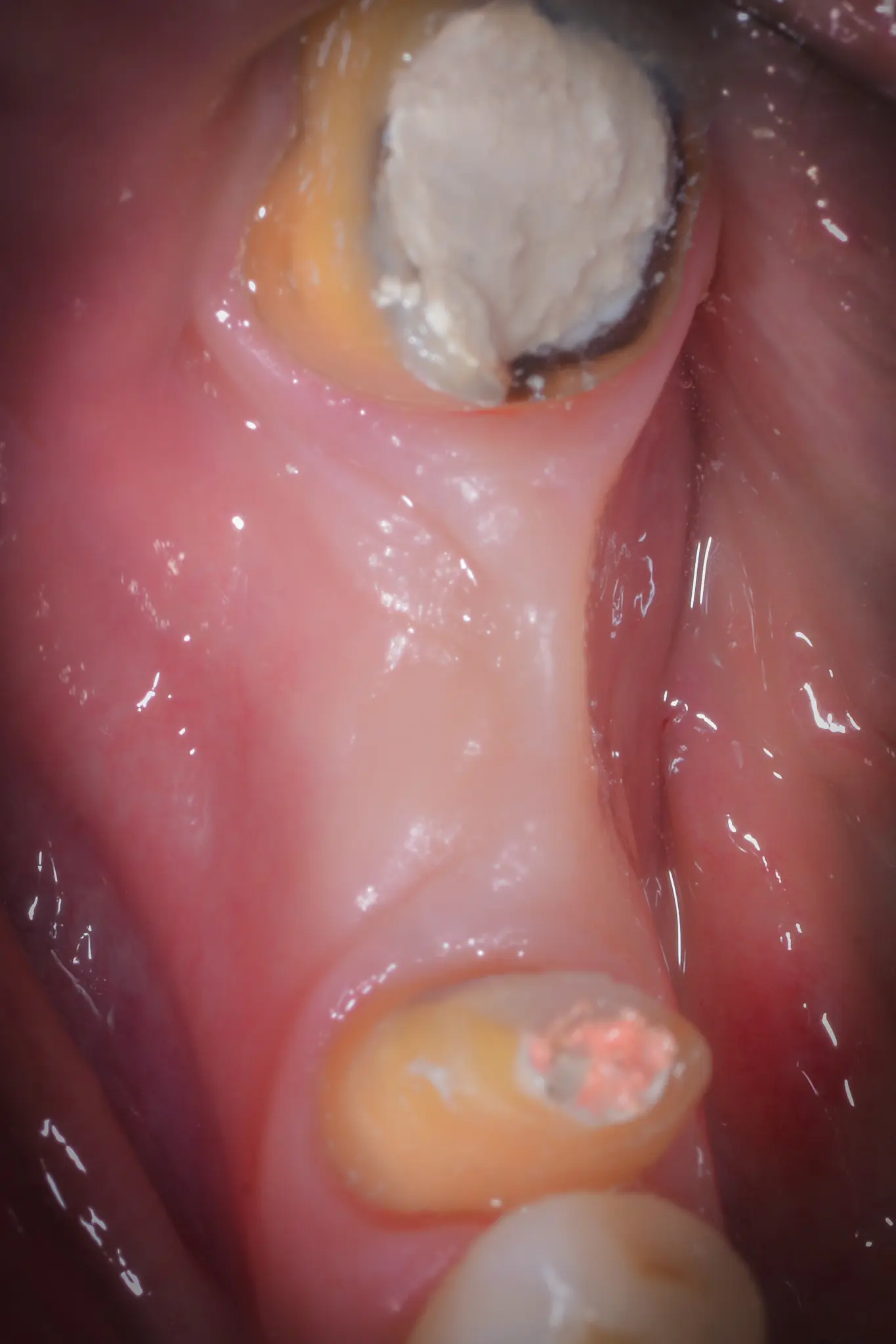 Vista clinica occlusale del sito edentulo 4.6 con difetto osteo-mucoso severo: cresta concava e cheratinizzata quasi assente; denti adiacenti in fase di trattamento endodontico