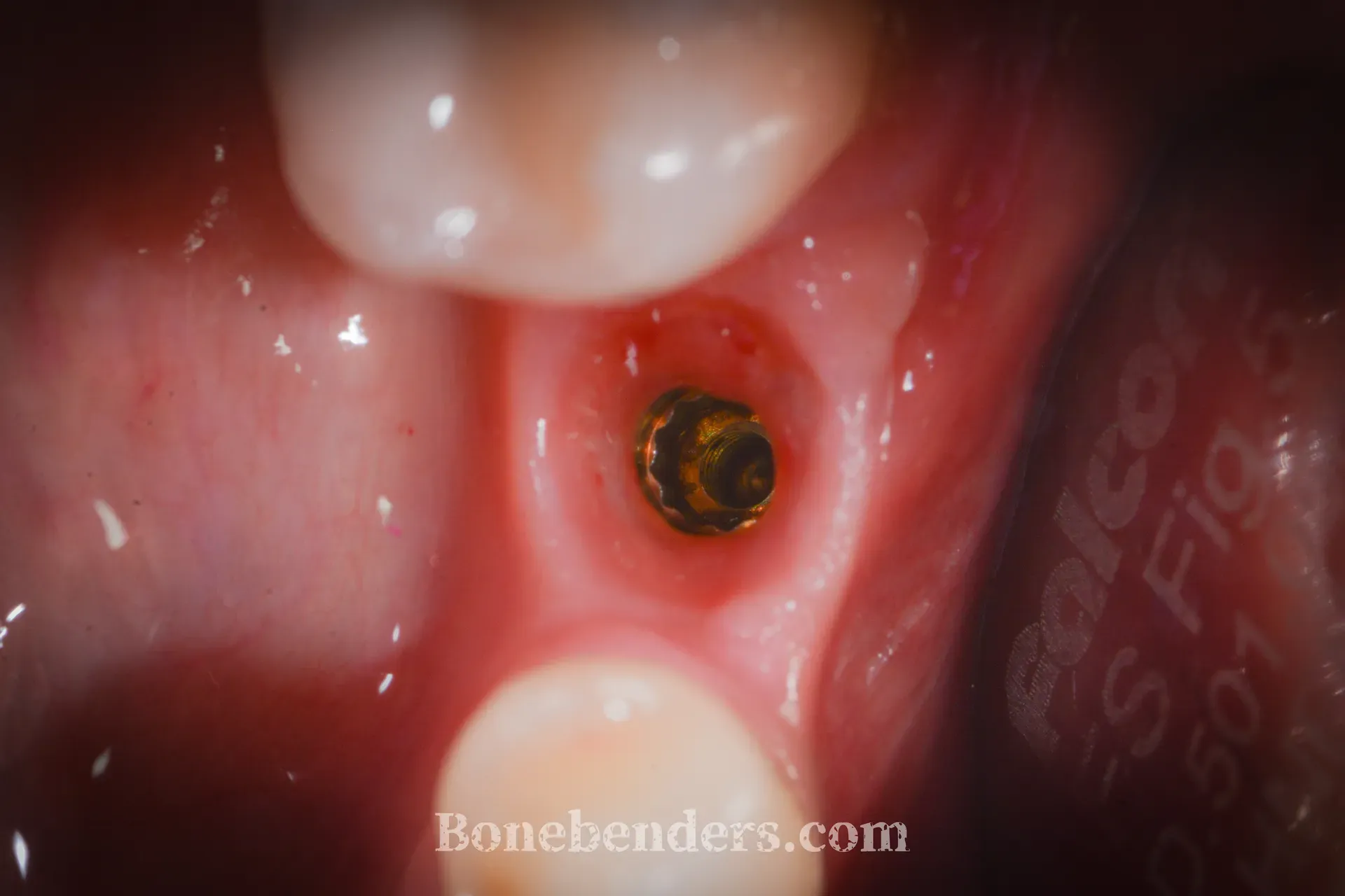 Impianto osteointegrato in cresta espansa — situazione clinica a 6 mesi