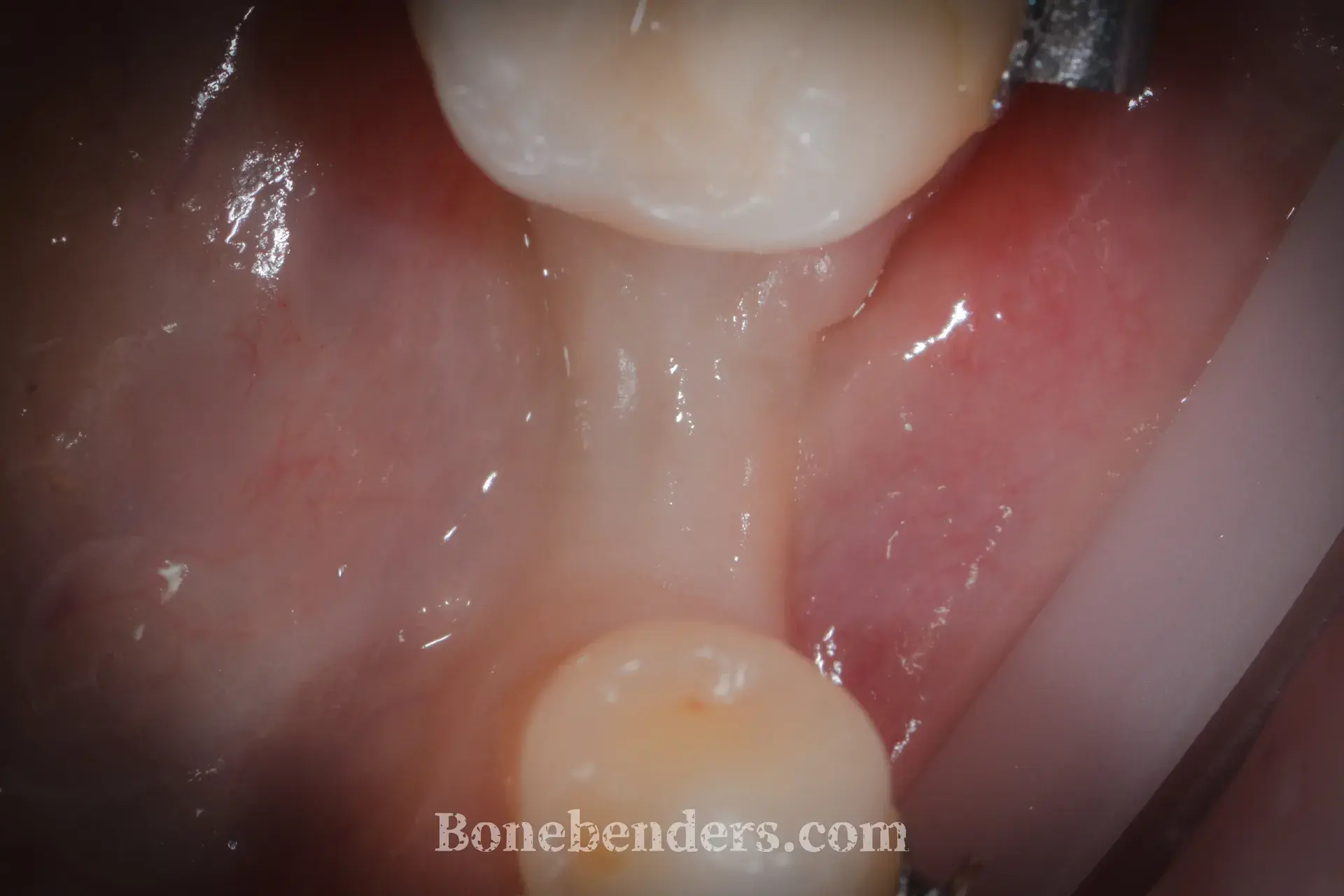 Cresta alveolare atrofica in zona secondo premolare inferiore sinistro — situazione clinica pre-operatoria