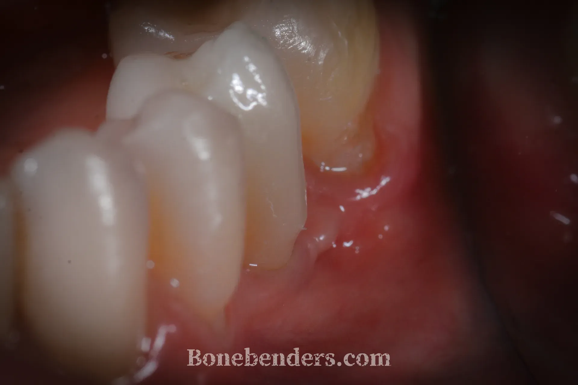 Corona in ceramica su impianto premolare inferiore sinistro — aspetto clinico finale
