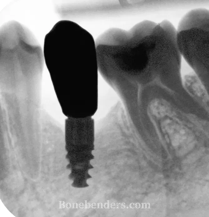 Radiografia periapicale di controllo a 12 mesi — impianto osteointegrato in zona premolare inferiore sinistro