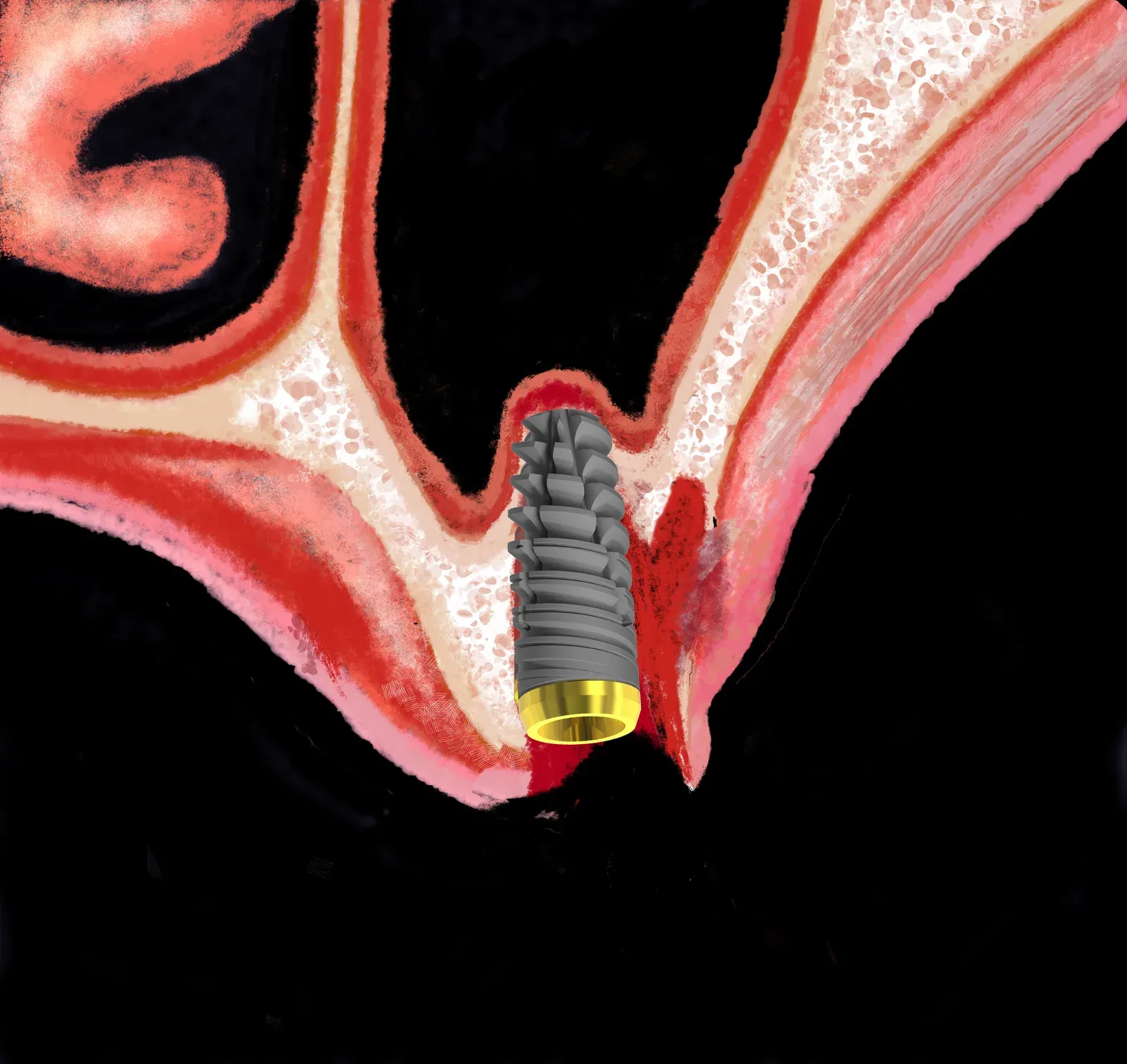 Maxillary cross-section with implant in a post-extraction socket: crestal approach and sinus membrane elevation