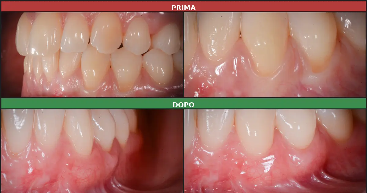 Recessione gengivale prima e dopo il trattamento chirurgico