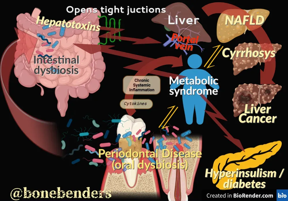 Diagramma che illustra la relazione tra disbiosi intestinale, malattie epatiche e sindrome metabolica, evidenziando le vie di infiammazione sistemica e le conseguenze sulla salute.
