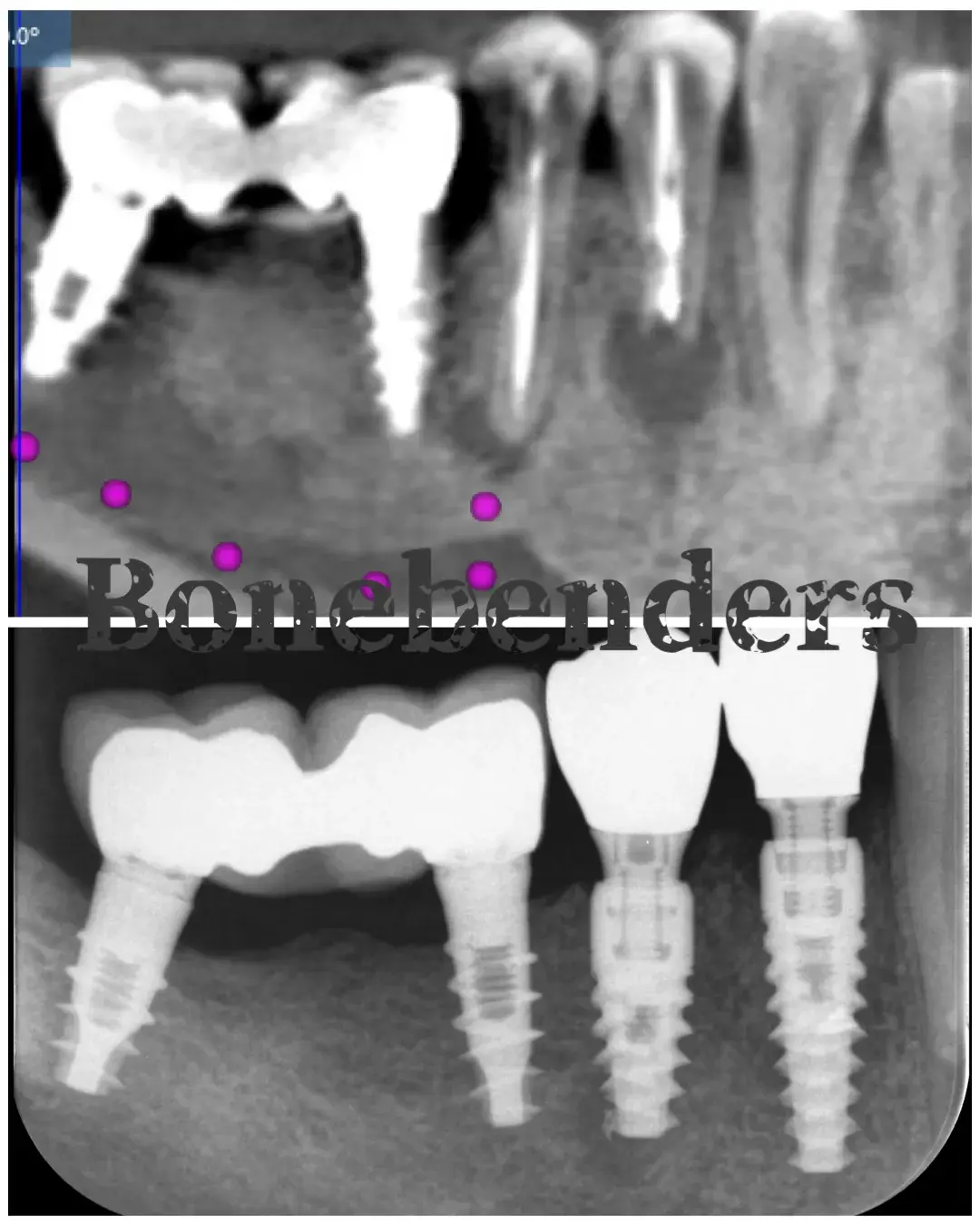 Immediate implant placement is almost always the best solution